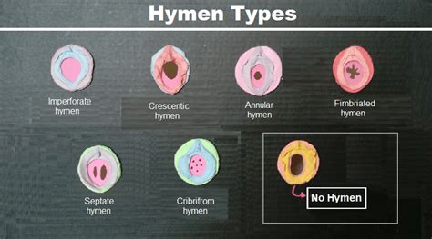 hymen pic|Types of Hymens